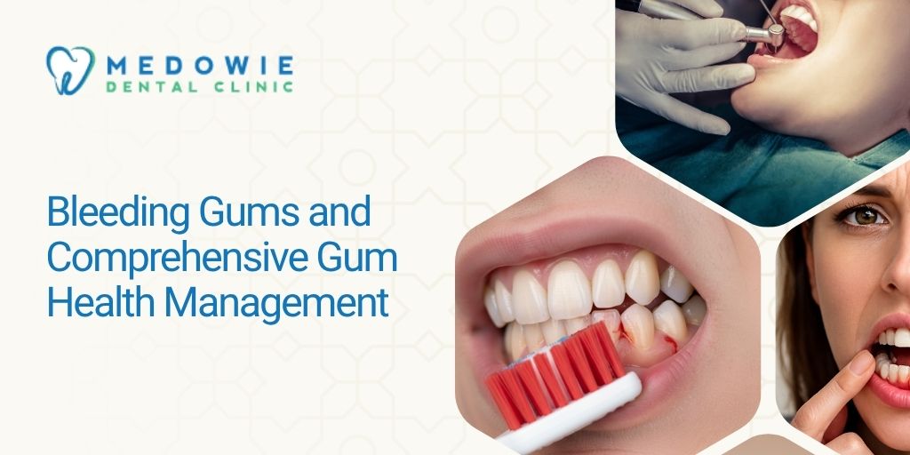 Bleeding Gums Solution